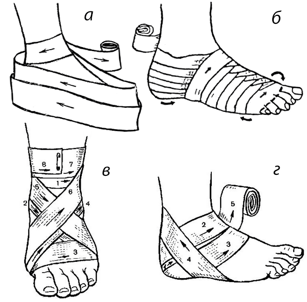 Повязки при повреждении стопы и голеностопного сустава