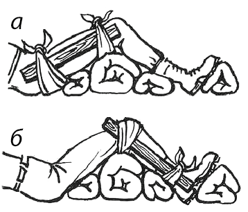Наложение шины при переломе бедра, голени